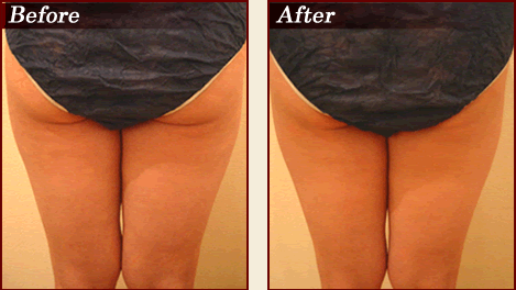 BeforeAfter
